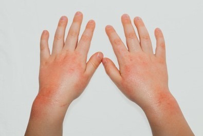 eczema problemas de pele