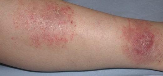 eczema na perna